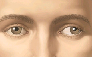 Ambliopia sau ochiul lenes - Dr. Marioara Pop