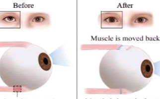 hyperopia amblyopia a rövidlátás a látásról szól