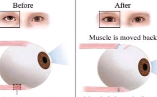 Myopia strabismus amblyopia