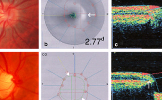 OCT Stratus optical coherence tomography