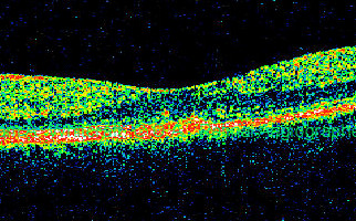 OCT Stratus optical coherence tomography